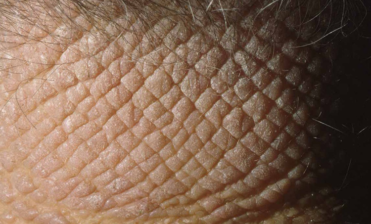 Lichen Simplex Chronicus Treatment in Hyderabad
