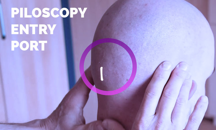 Scarless Hair Transplant Surgery in Hyderabad