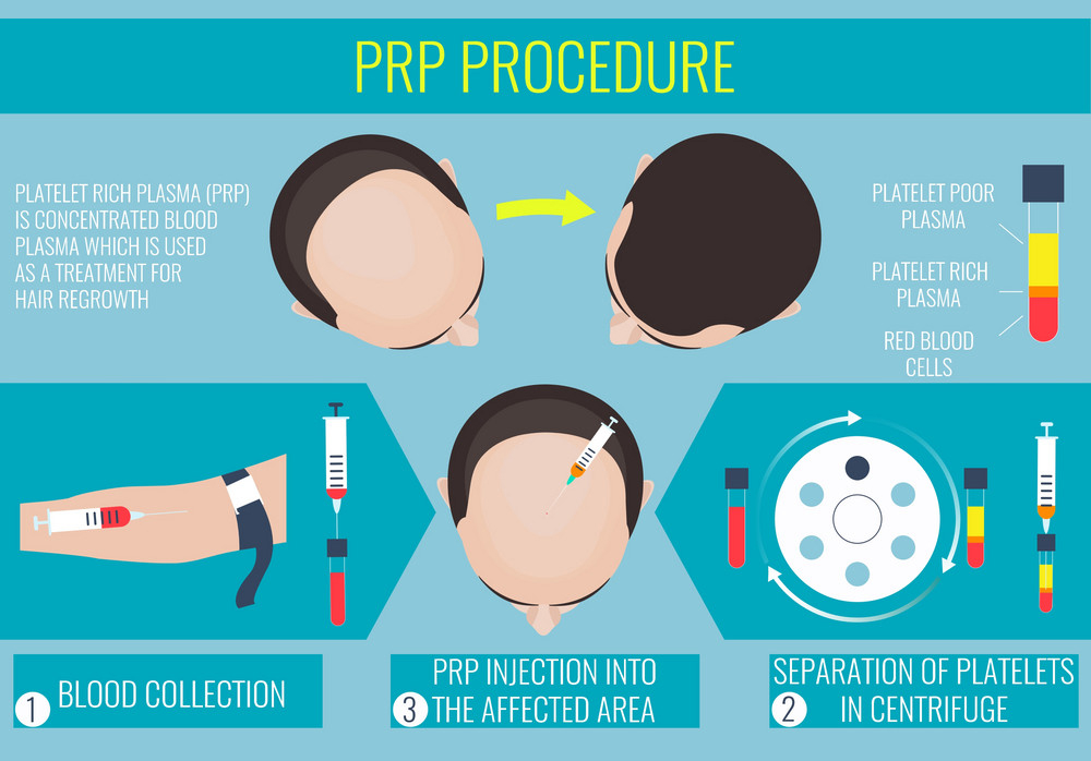 Benefits of an effective PRP hair treatment in Hyderabad