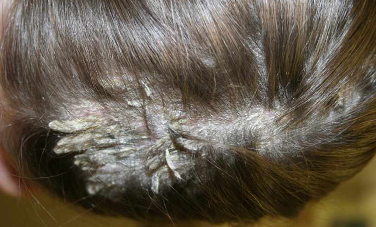 Pityriasis Amiantacea Hair Treatment in Hyderabad