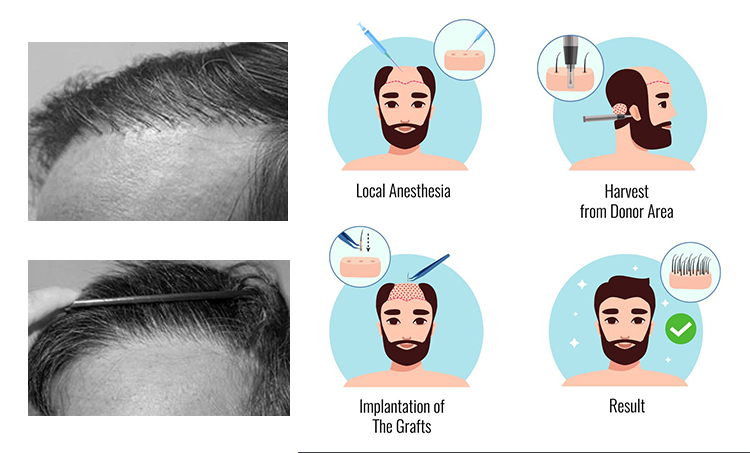 Trichos | Hair Restoration | Corrective Hair Transplant Trichos | Hair Restoration | Corrective Hair Transplant
