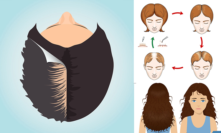 Hair Fall Treatment in Gorakhpur  Mukhija Skin  Laser Clinic