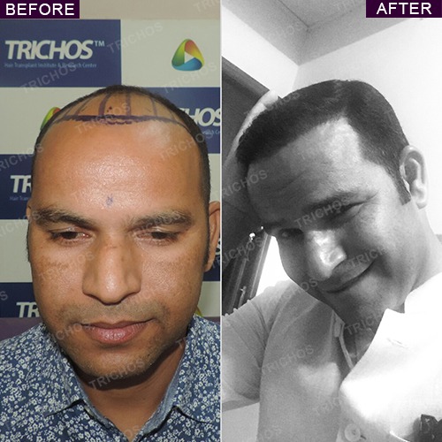 Trichos | Hair Transplant Before & After Photos | Results Trichos | Hair Transplant Before & After Photos | Results