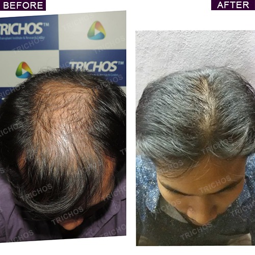 Trichos | Hair Transplant Before & After Photos | Results Trichos | Hair Transplant Before & After Photos | Results