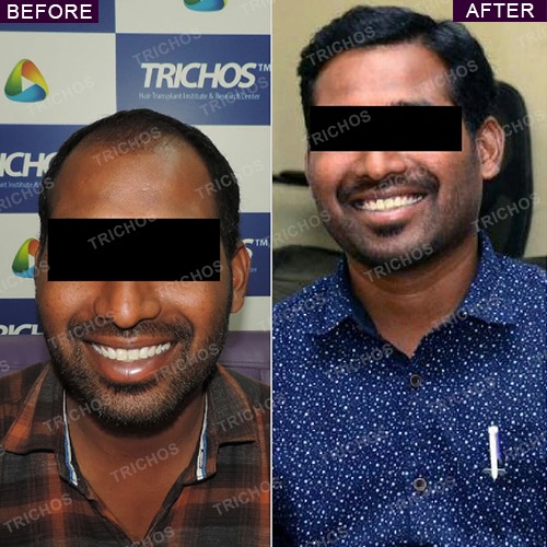 Trichos | Hair Transplant Before & After Photos | Results Trichos | Hair Transplant Before & After Photos | Results