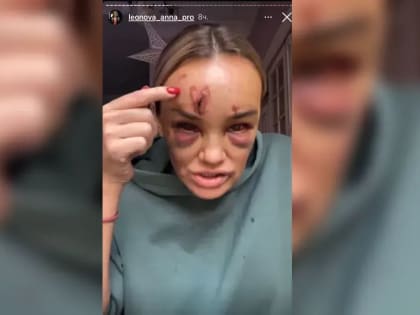 Избитая мужчиной во дворе журналистка пожаловалась, что вынуждена спать в коридоре больницы