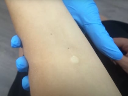 Можно ли мочить пробу Манту? Педиатр раскрыла правду о популярной в России прививке