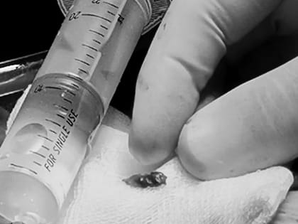 «Пациент жив, утром начал дышать самостоятельно». Осколок снаряда достали московские хирурги из сердца военного