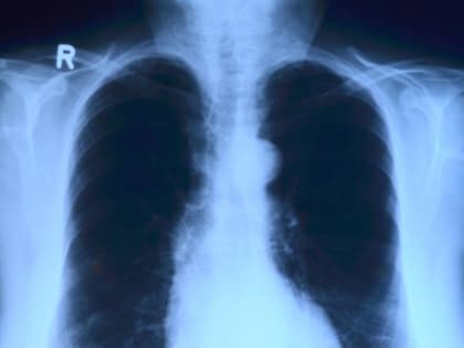 Петербургские ученые открыли инновационный способ лечения тромбоэмболии легких