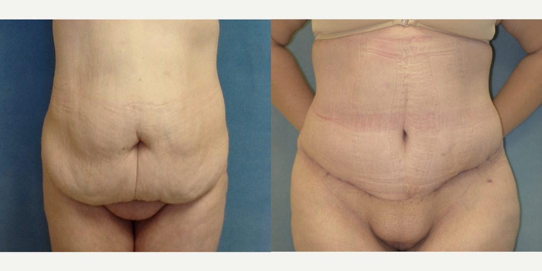 Tummy Tuck (Abdominoplasty) procedure image
