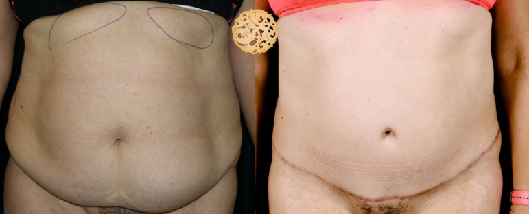 Skin Tightening procedure image