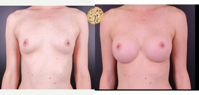 Breast Augmentation procedure image