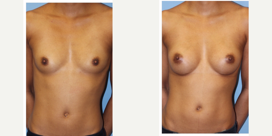 Mommy Makeover procedure image