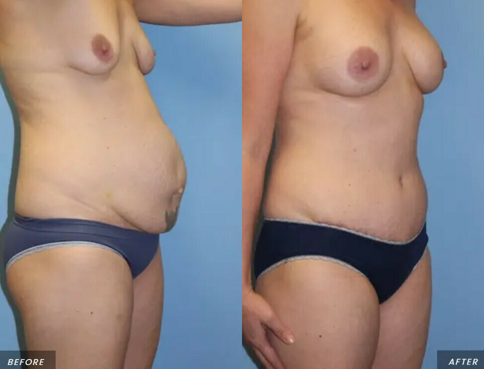 Skin Tightening procedure image