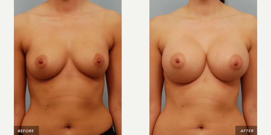 Breast Augmentation procedure image
