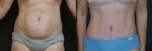 Skin Tightening procedure image