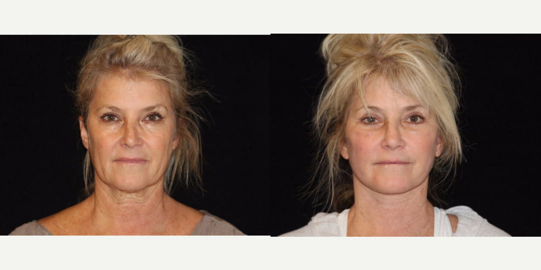 Facelift procedure image