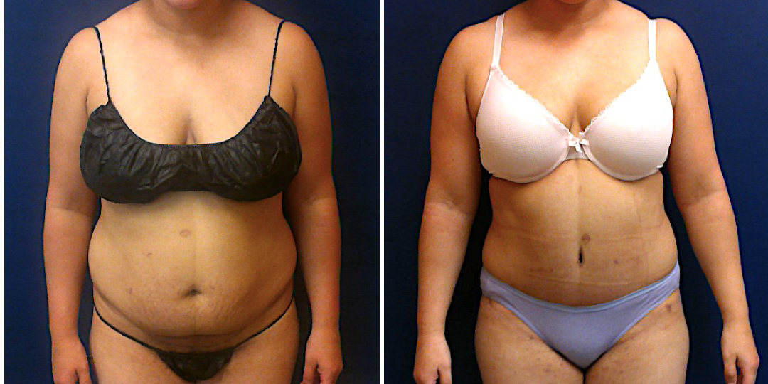 Mommy Makeover procedure image