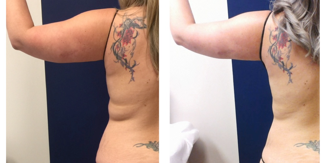 Body Lift procedure image