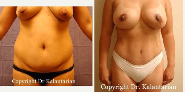 Breast Augmentation procedure image