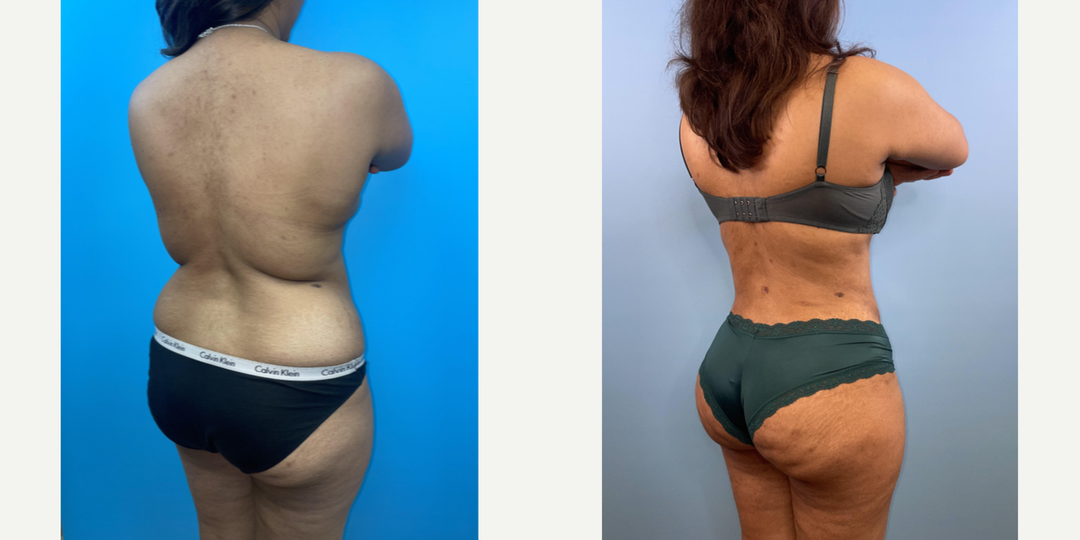 Mommy Makeover procedure image