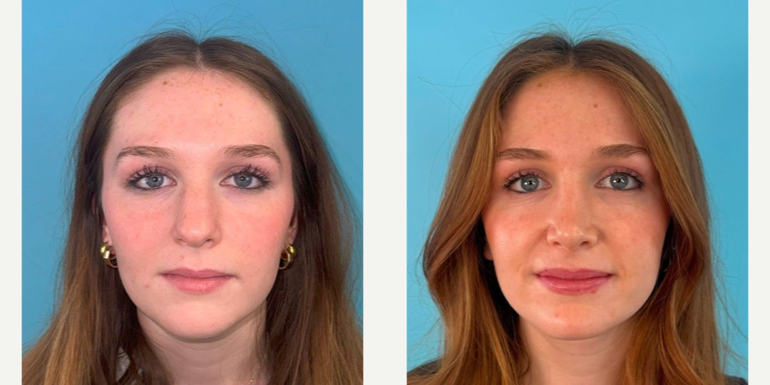 Rhinoplasty (Nose Job) procedure image