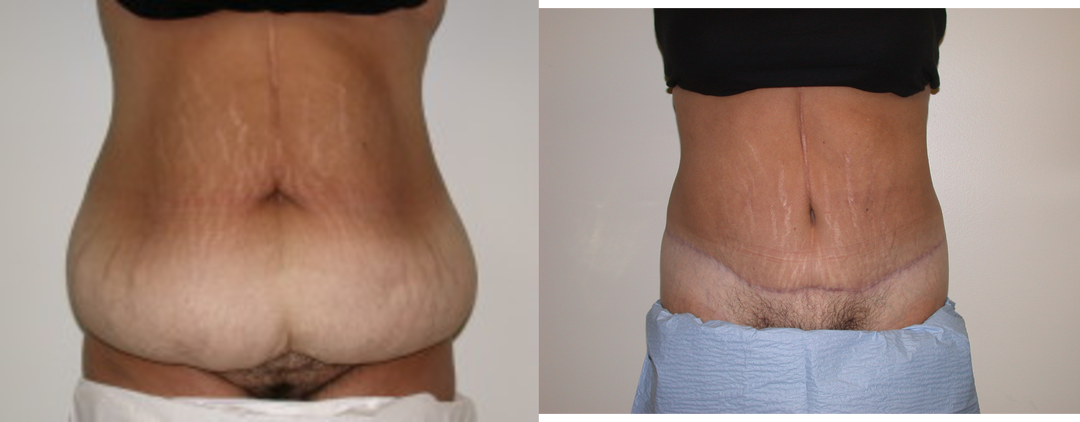 Skin Tightening procedure image