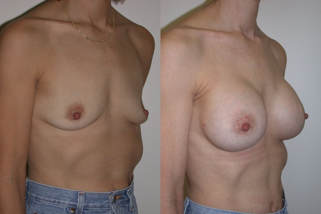 Breast Augmentation procedure image