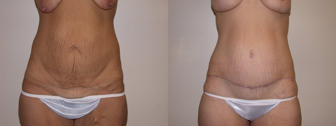 Mommy Makeover procedure image