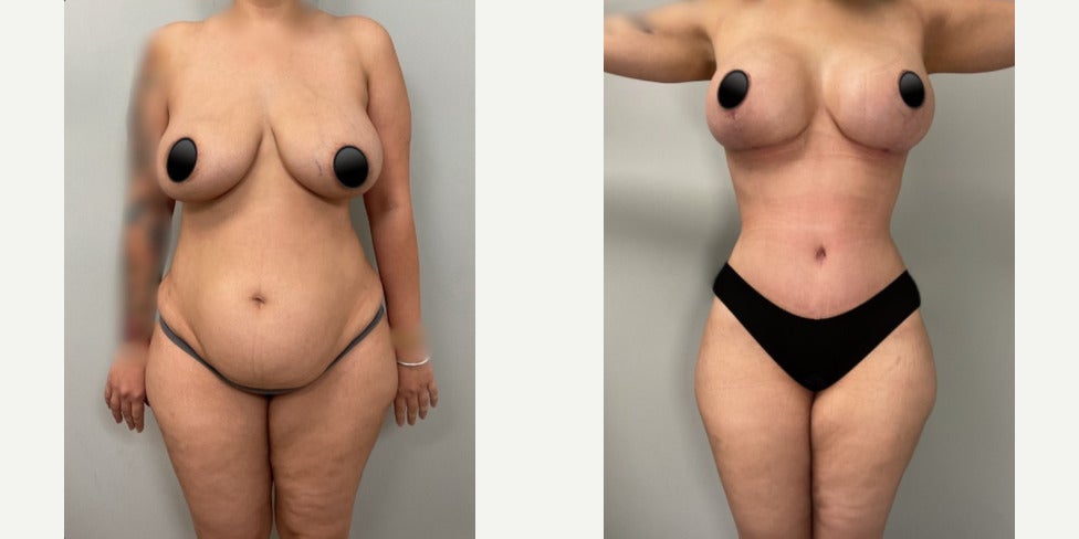 Breast Augmentation procedure image