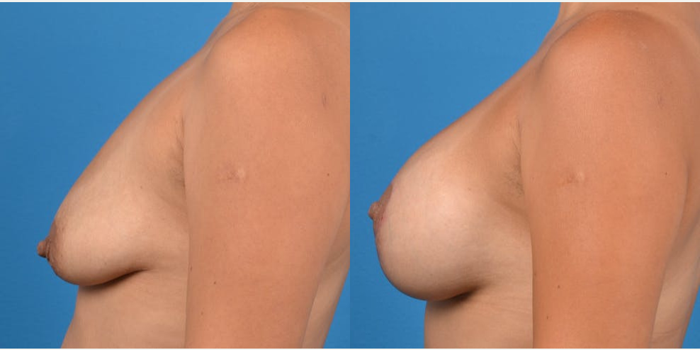 Mommy Makeover procedure image