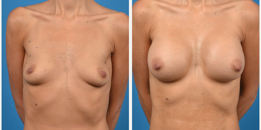 Breast Augmentation procedure image