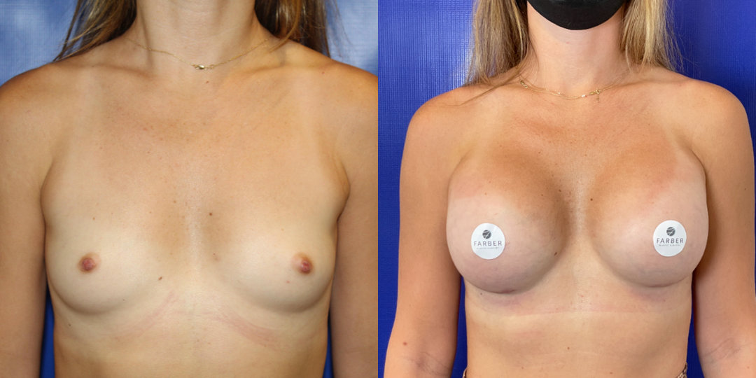 Breast Augmentation procedure image