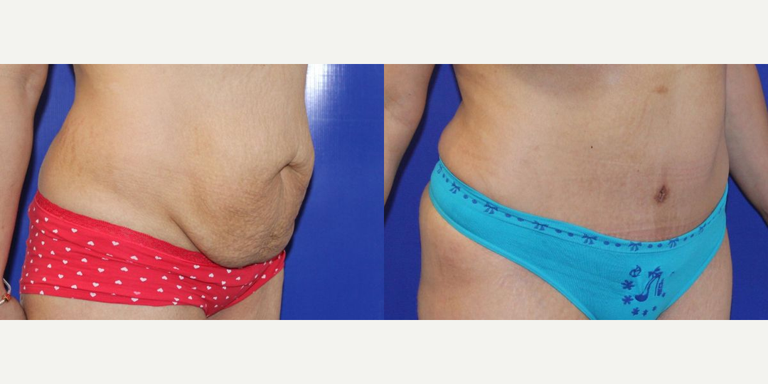 Skin Tightening procedure image