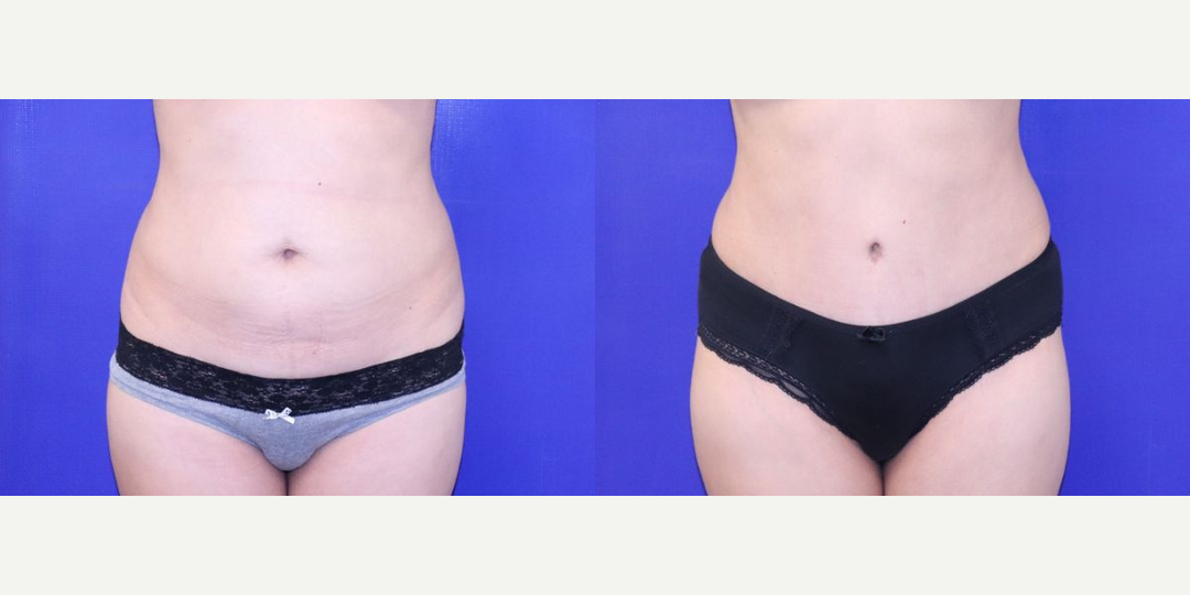 Mommy Makeover procedure image