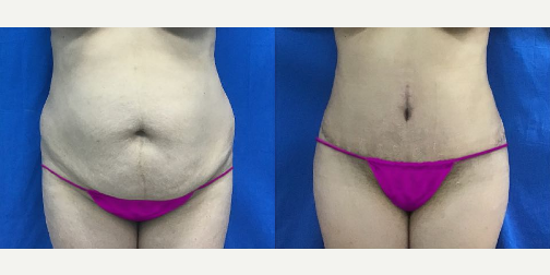 Tummy Tuck (Abdominoplasty) procedure image