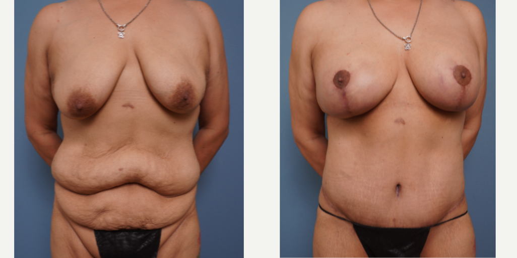 Skin Tightening procedure image