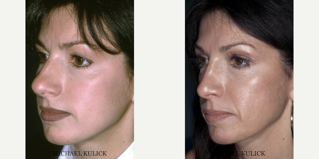 Rhinoplasty (Nose Job) procedure image