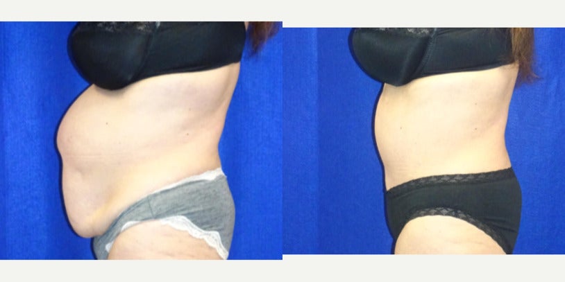 Tummy Tuck (Abdominoplasty) procedure image