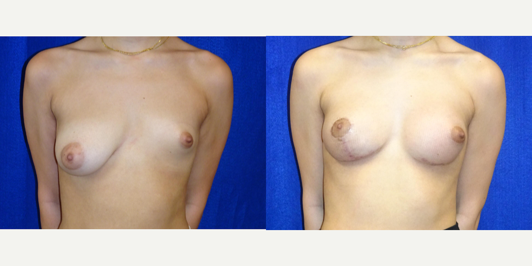 Breast Augmentation procedure image