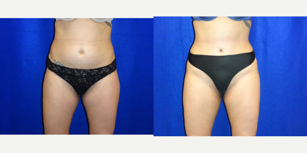 Mommy Makeover procedure image