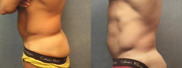 Mommy Makeover procedure image