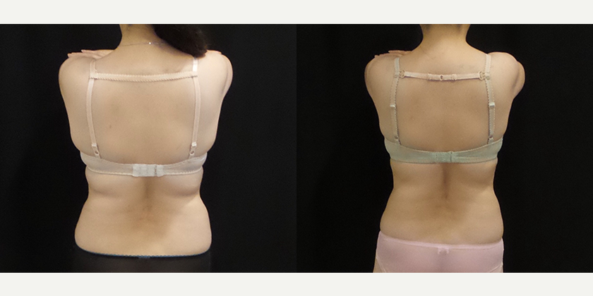 Lipo 360 procedure image