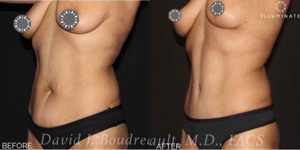 Mommy Makeover procedure image