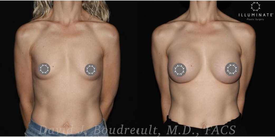 Breast Augmentation procedure image