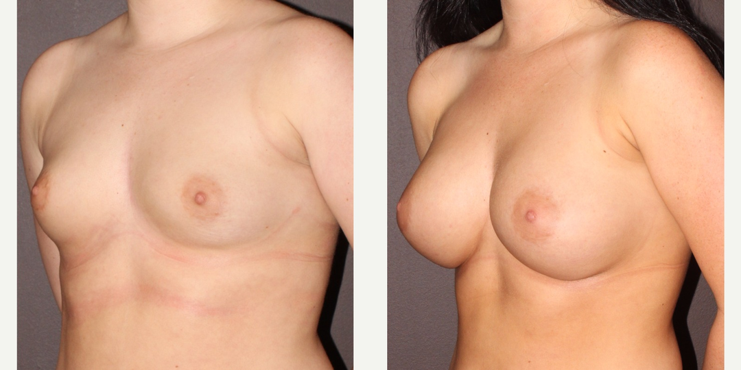 Breast Augmentation procedure image