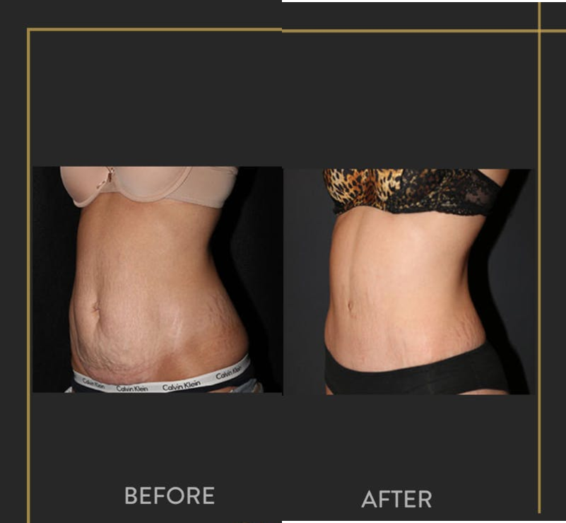 Tummy Tuck (Abdominoplasty) procedure image