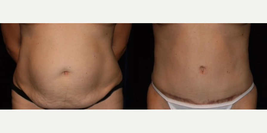 Skin Tightening procedure image