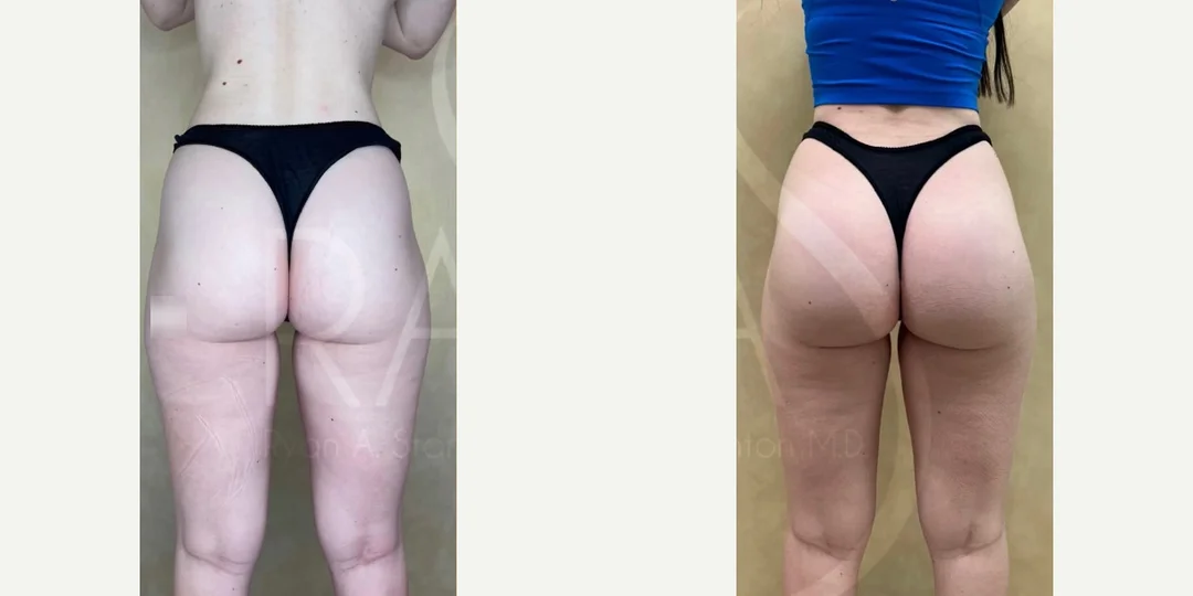 Hip Enhancement procedure image