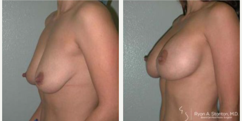 Breast Augmentation procedure image